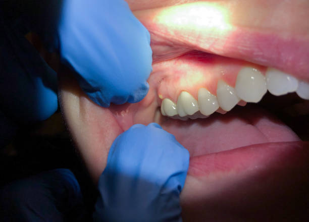 Best Emergency Treatment for Toothache in Hillsborough, NC